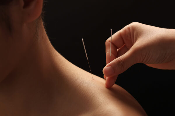 Acupuncture